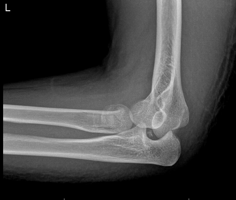 Elbow Dislocation Trauma Orthobullets